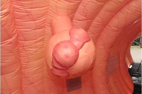 Teile des Polypen sind zu Krebs entartet.

© Felix Burda Stiftung
