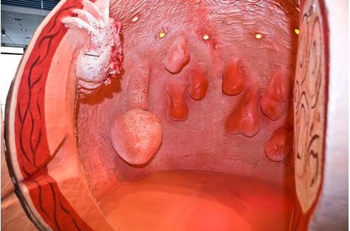 ... Wucherungen, die in der Muskelschicht der Gebärmutter (Myometrium) auftreten.

© www.organmodelle.de