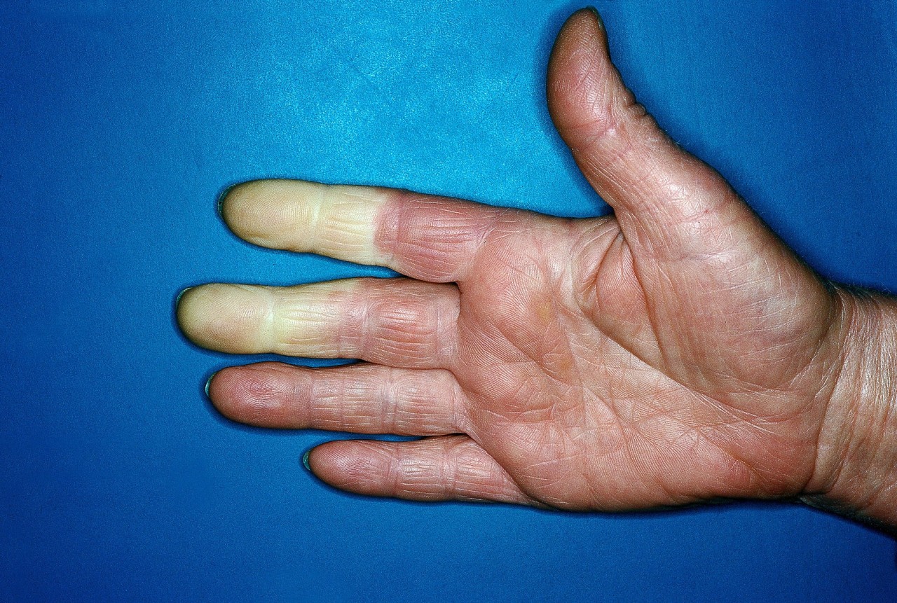Das Raynaud-Syndrom: Plötzlich verfärben sich Finger weiß.  