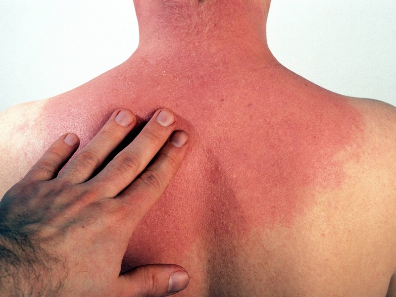 Die UV-B-Strahlen sind für den akuten Sonnenbrand verantwortlich. Sie erreichen nur die oberen Hautschichten. Doch auch die UV-A-Strahlen verursachen Schäden. Sie dringen in tiefere Hautschichten ein, treiben die Hautalterung voran und steigern ebenfalls das Risiko, an Hautkrebs zu erkranken.