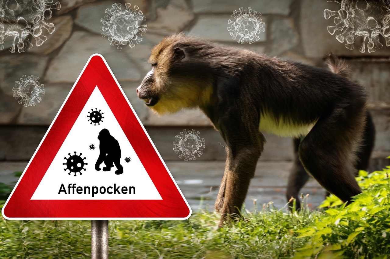 Affenpocken in NRW: Neue Fälle bestätigt. (Symbolbild)