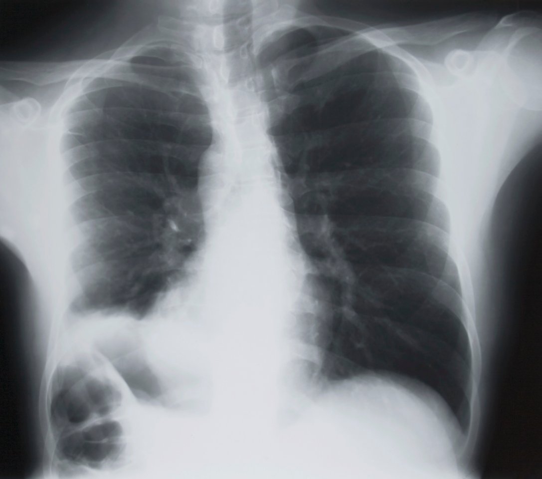 Lungen Röntgenbild.jpg