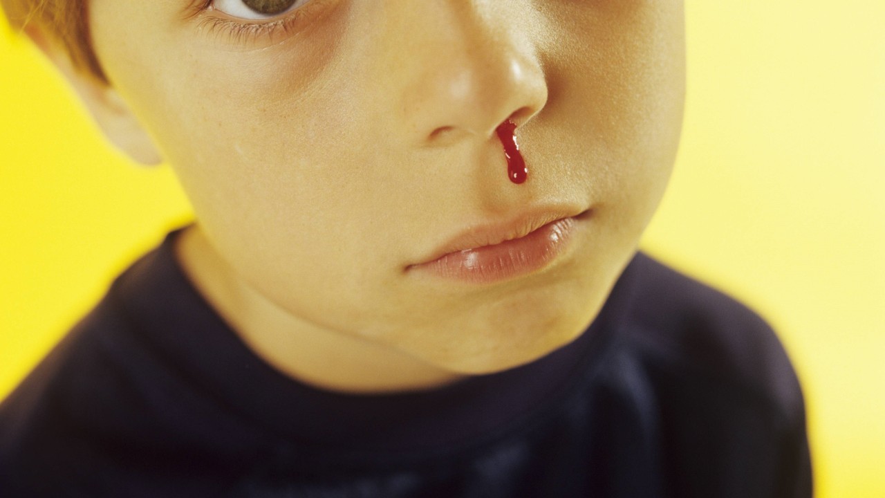 In Dortmund wurde ein Junge so heftig von einer fremden Frau geohrfeigt, dass er Nasenbluten bekam. (Symbolbild)