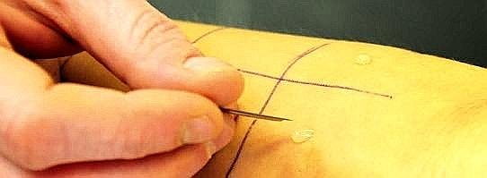 Allergietest - Pricktest--543x199.jpg