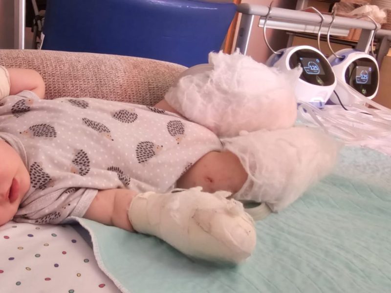 Baby Ava aus Oberhausen verliert beide Beine: Familie braucht dringend Hilfe